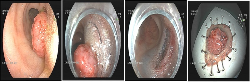 ESD POLYP