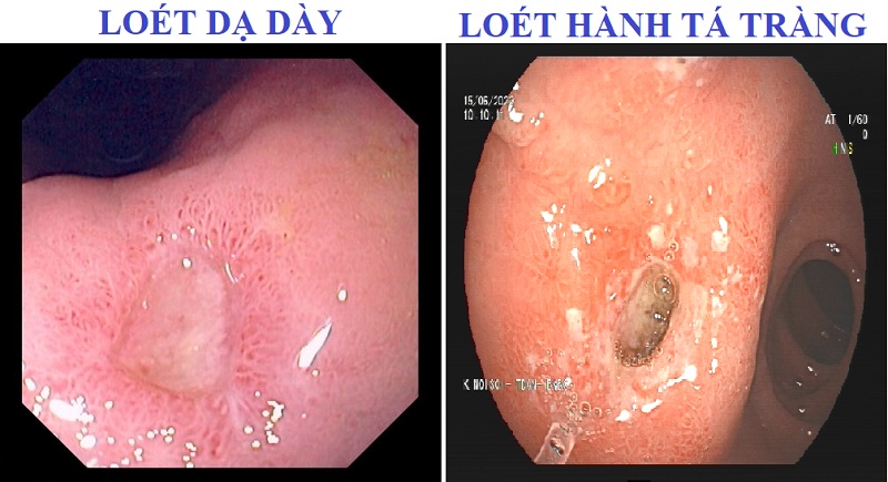 LOÉT DẠ DÀY HTT