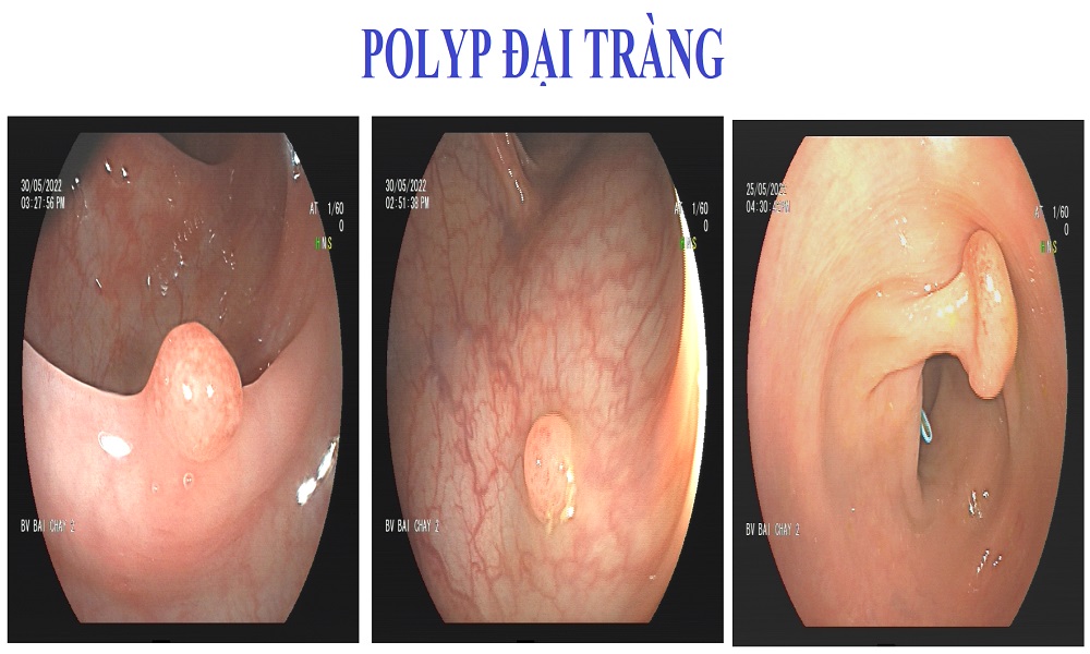 POLYP ĐẠI TRÀNG