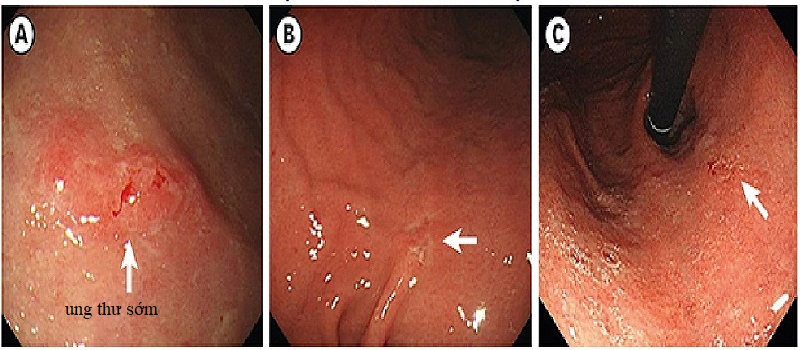 UNG THƯ SỚM  dạ dày