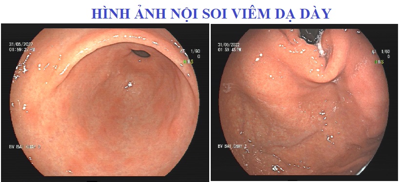 Viêm dạ dày là gì, nguyên nhân, triệu chứng, biến chứng, điều trị