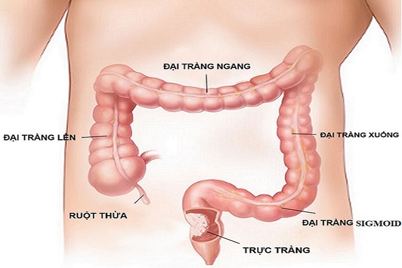 chuẩn bị đại tràng