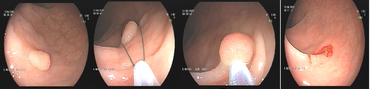 cắt polyp