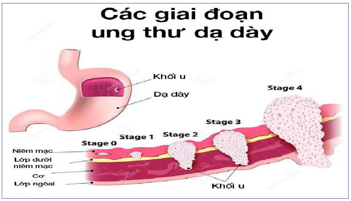 giai đoạn k dạ dày