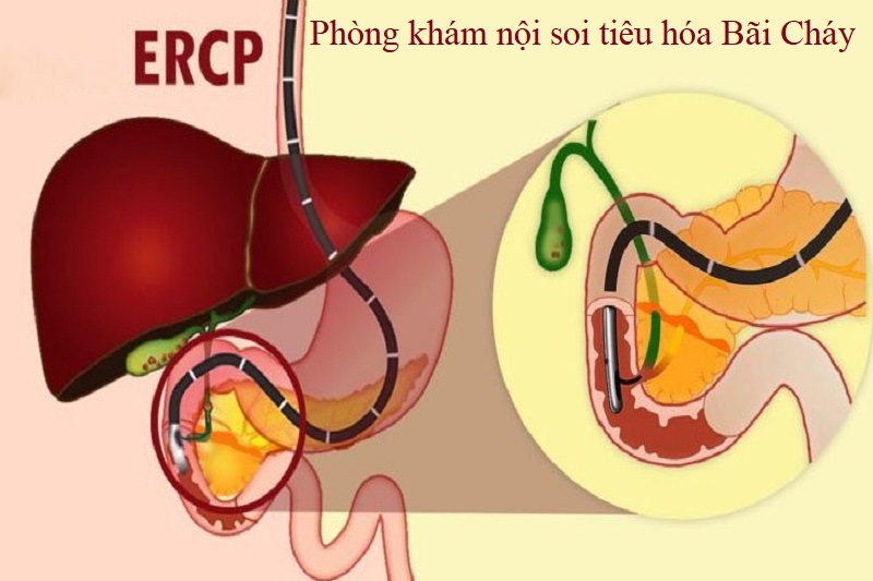 mật tụy ngược dòng