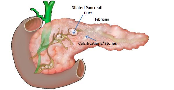 pancreatic