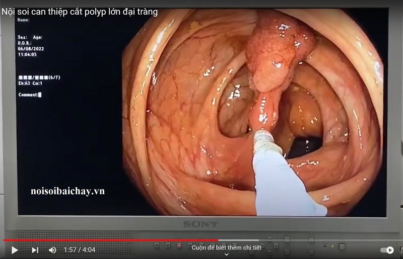 Cắt Polyp đại tràng như thế nào, video can thiệp cắt Polyp đại tràng