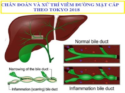 Hướng dẫn chẩn đoán điều trị viêm đường mật cấp