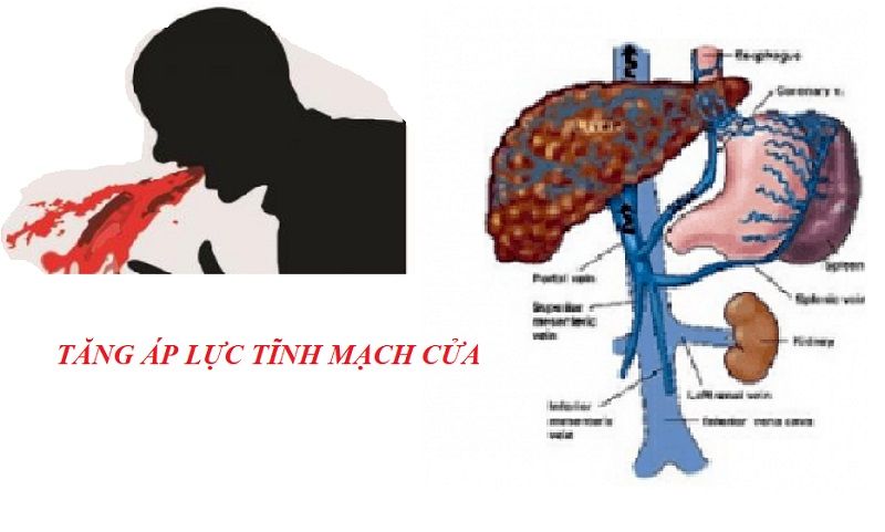 Xuất huyết tiêu hóa trên do tăng áp lực tĩnh mạch cửa