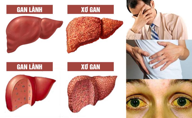 Xét nghiệm gan, chức năng gan, sinh hoá gan