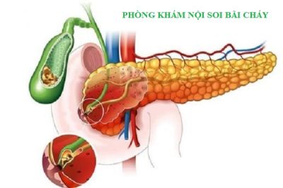 Chẩn đoán và điều trị viêm tụy cấp