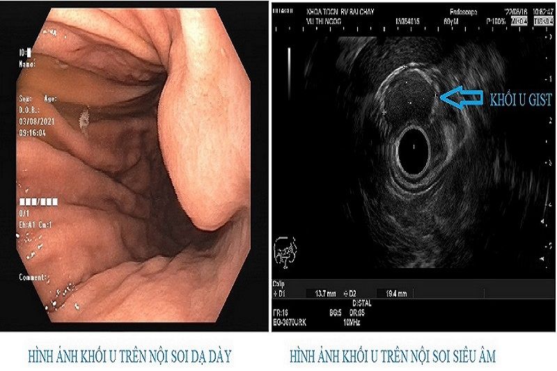 U dưới niêm mạc đường tiêu hóa, u dạ dày, u đại tràng