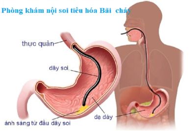 NỘI SOI DẠ DÀY LÀ GÌ, CÁC PHƯƠNG PHÁP NỘI SOI, CÁC TRIỆU CHỨNG DẠ DÀY TÁ TRÀNG