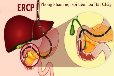 NỘI SOI MẬT TỤY NGƯỢC DÒNG ERCP LÀ GÌ, CAN THIỆP ĐƯỜNG MẬT, ĐIỀU TRỊ SỎI MẬT QUA ERCP