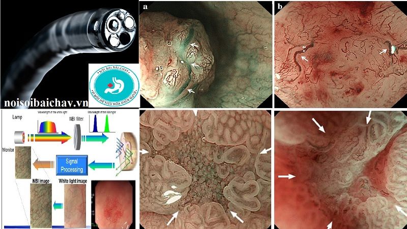 Chẩn đoán ung thư sớm thực quản, nội soi phóng đại, nội soi giải tần hẹp